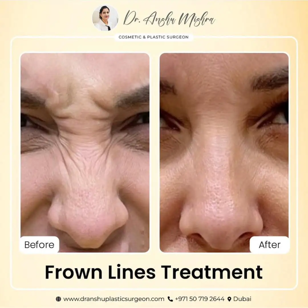 Facelift Surgery In Dubai