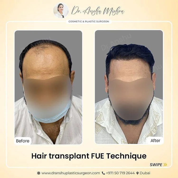 Before & After