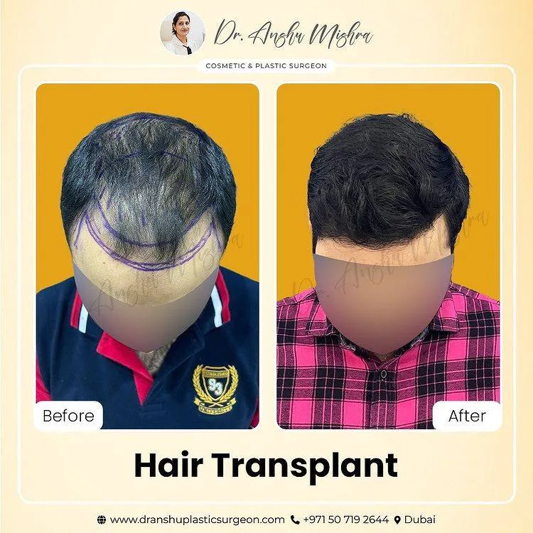 Before & After