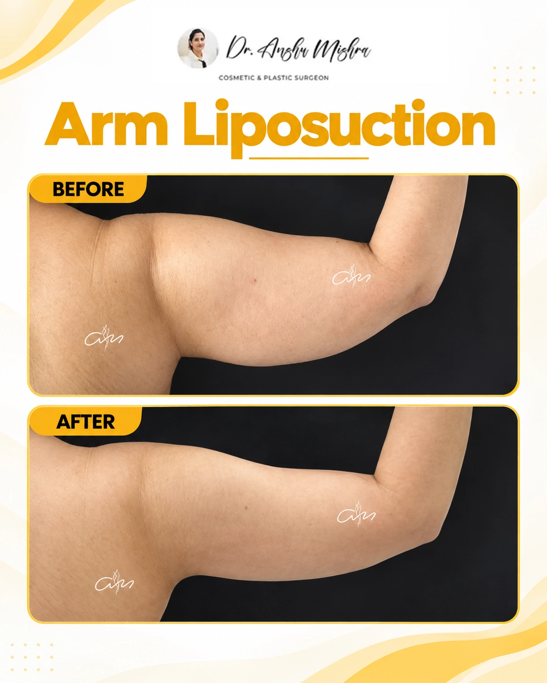 Arm Liposuction