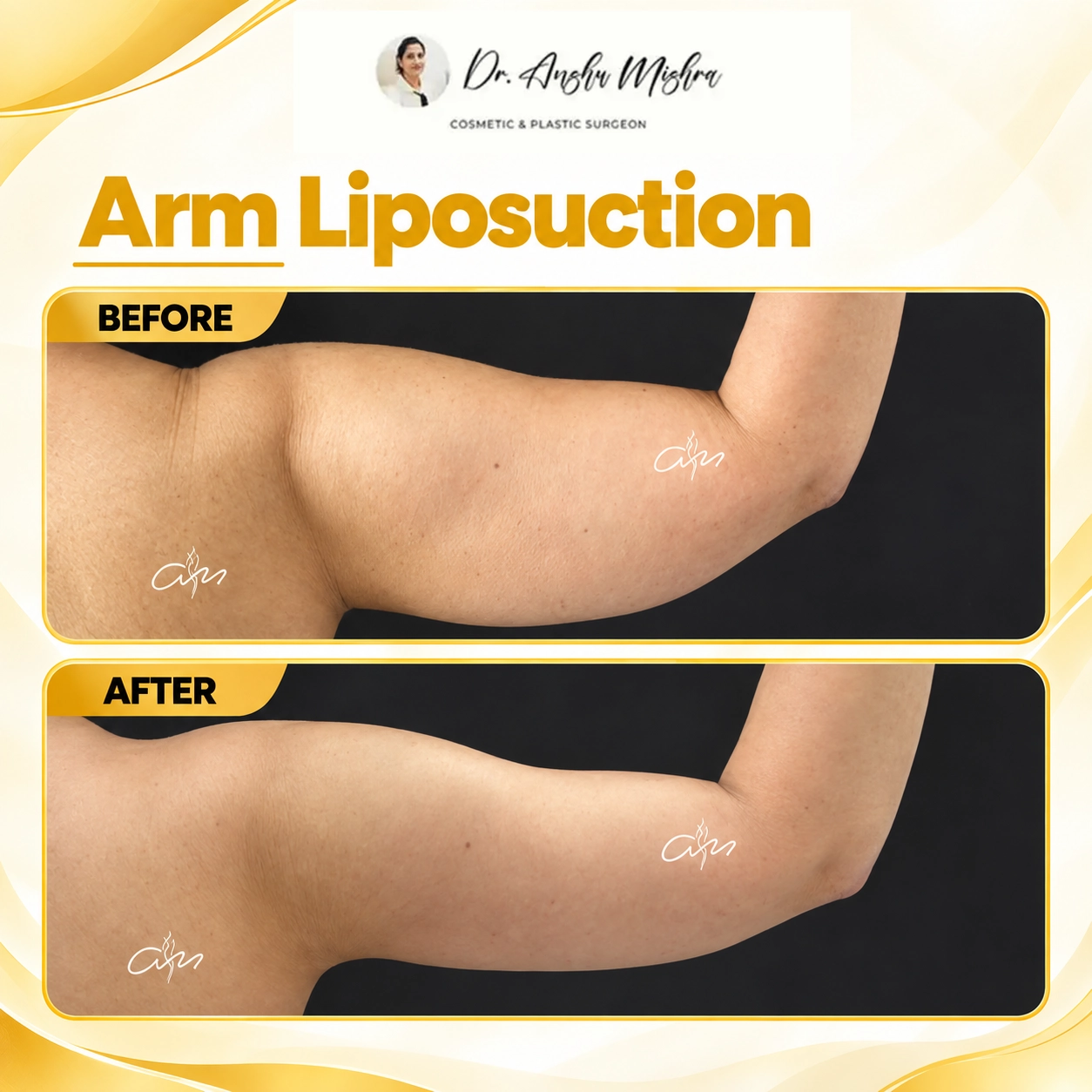 Arm Liposuction
