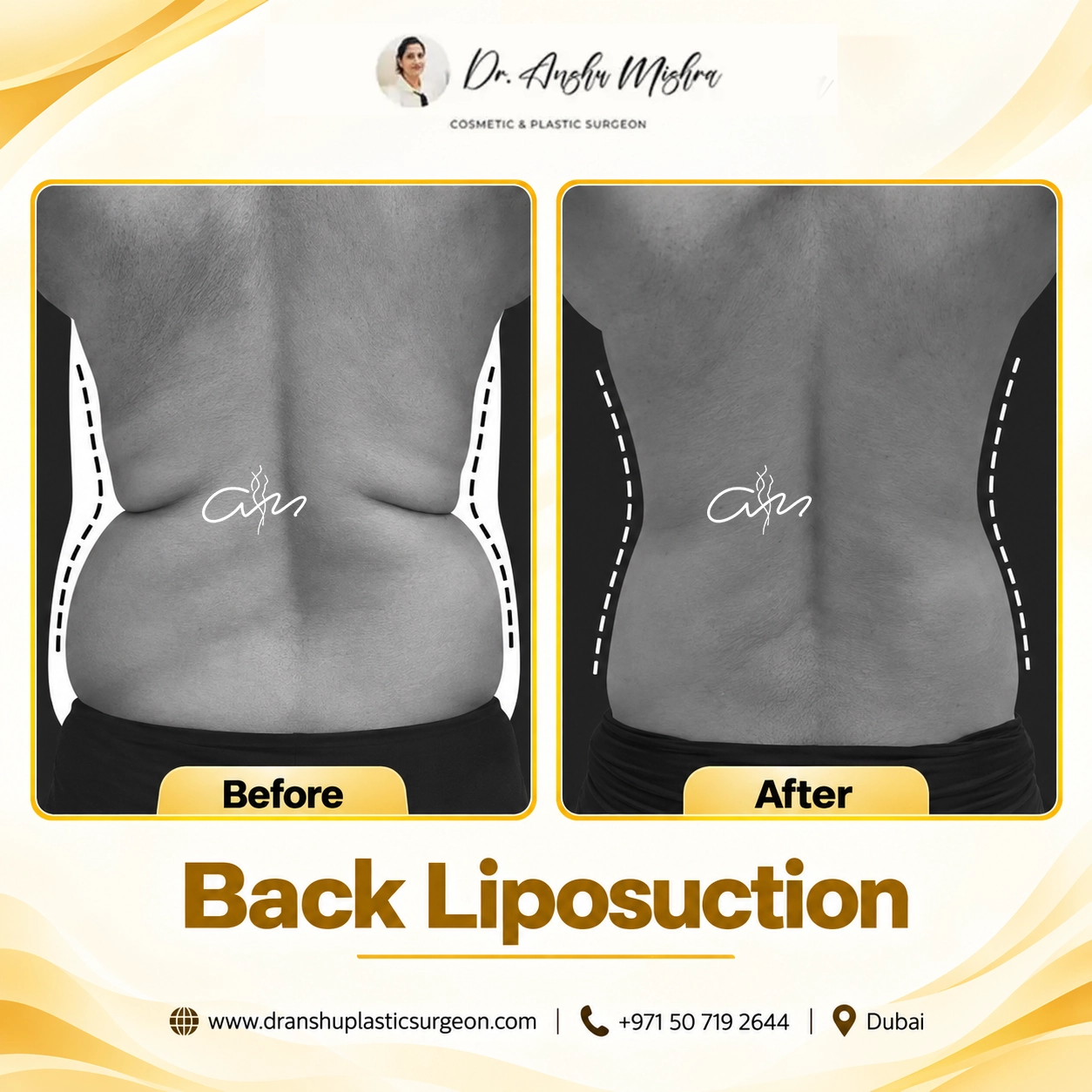 Back Liposuction