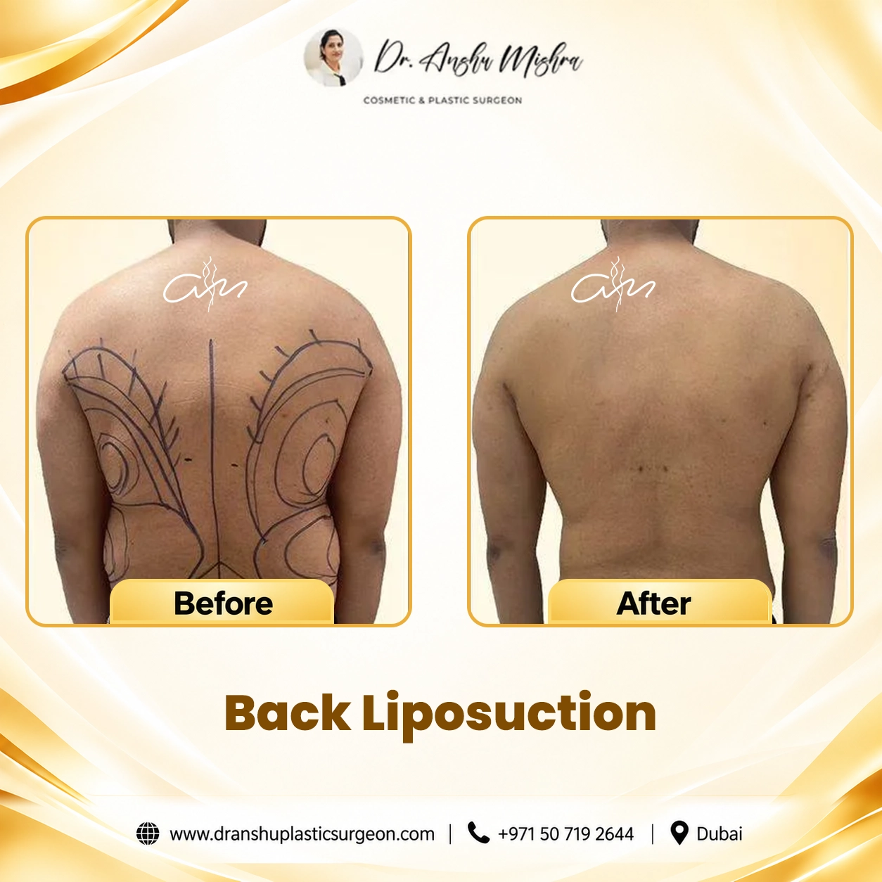 Back Liposuction