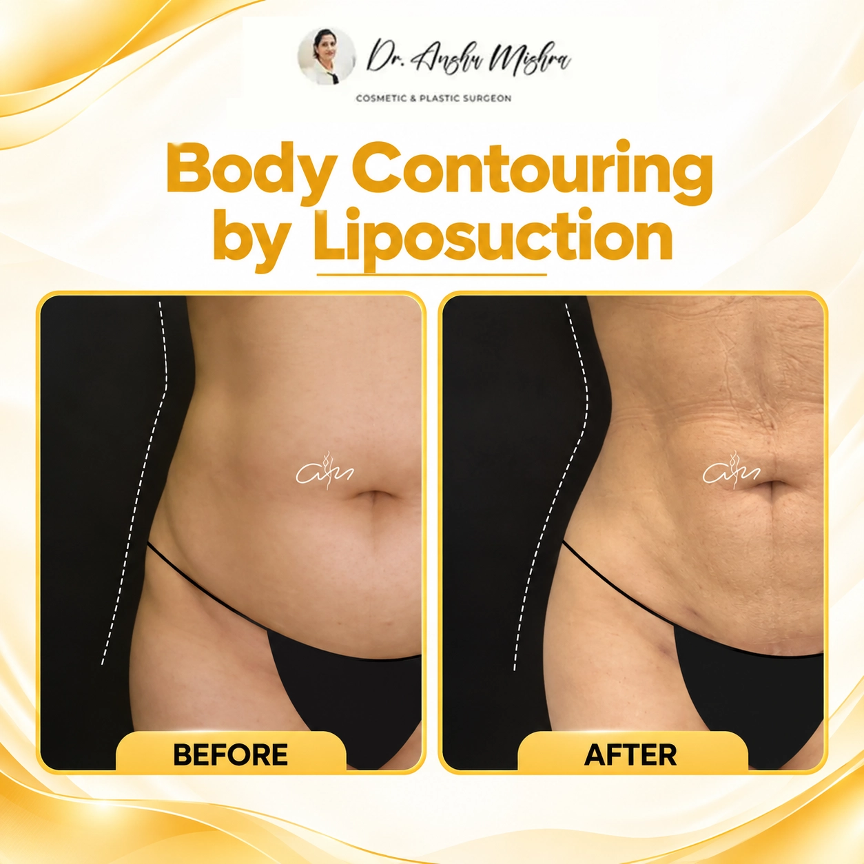 Body Contouring by Liposuction