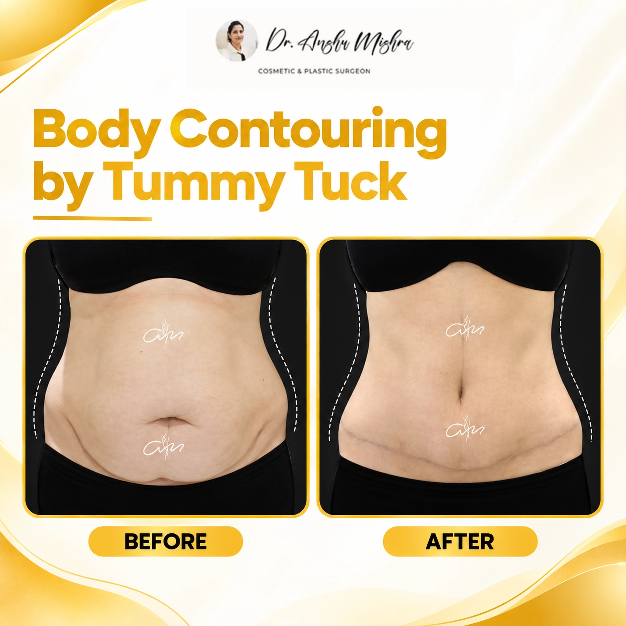 Body Contouring by Tummy Tuck