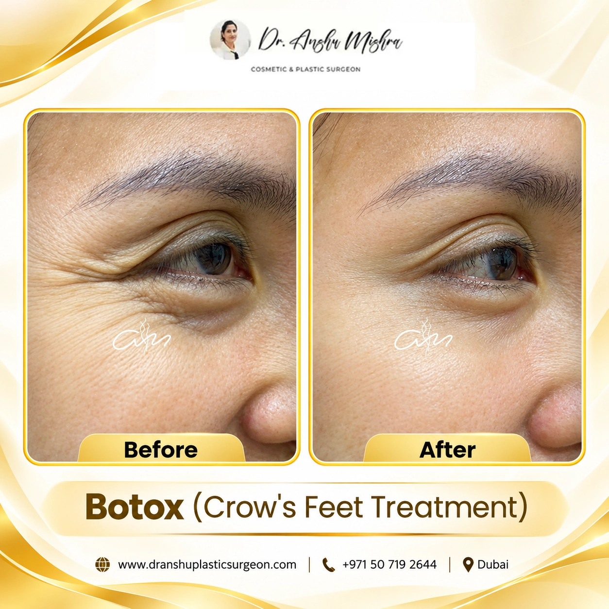 Botox (Crow's Feet Treatment)