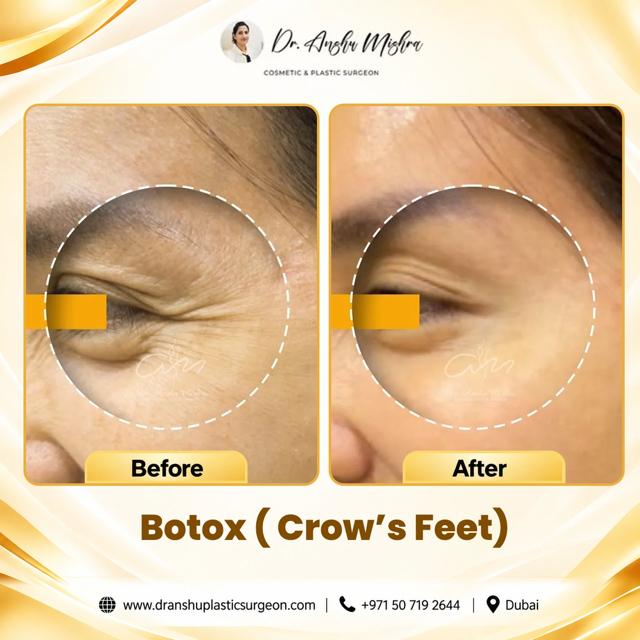 Botox (Crow's Feet)