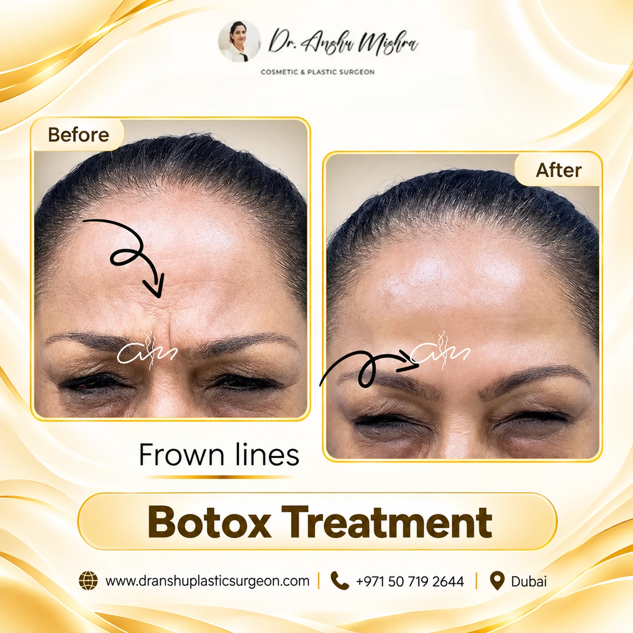 Botox Treatment - Frown Lines