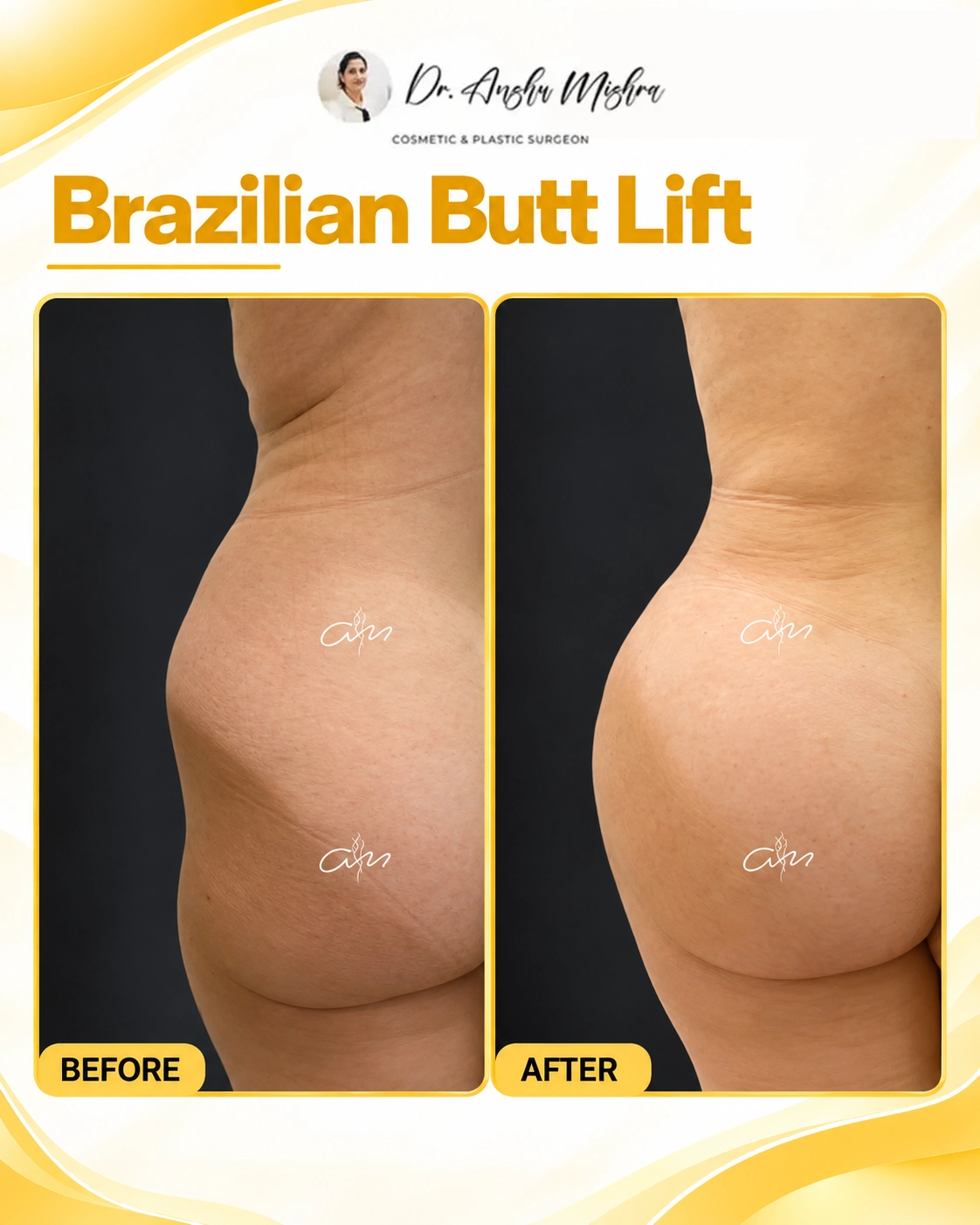 Brazilian Butt Lift