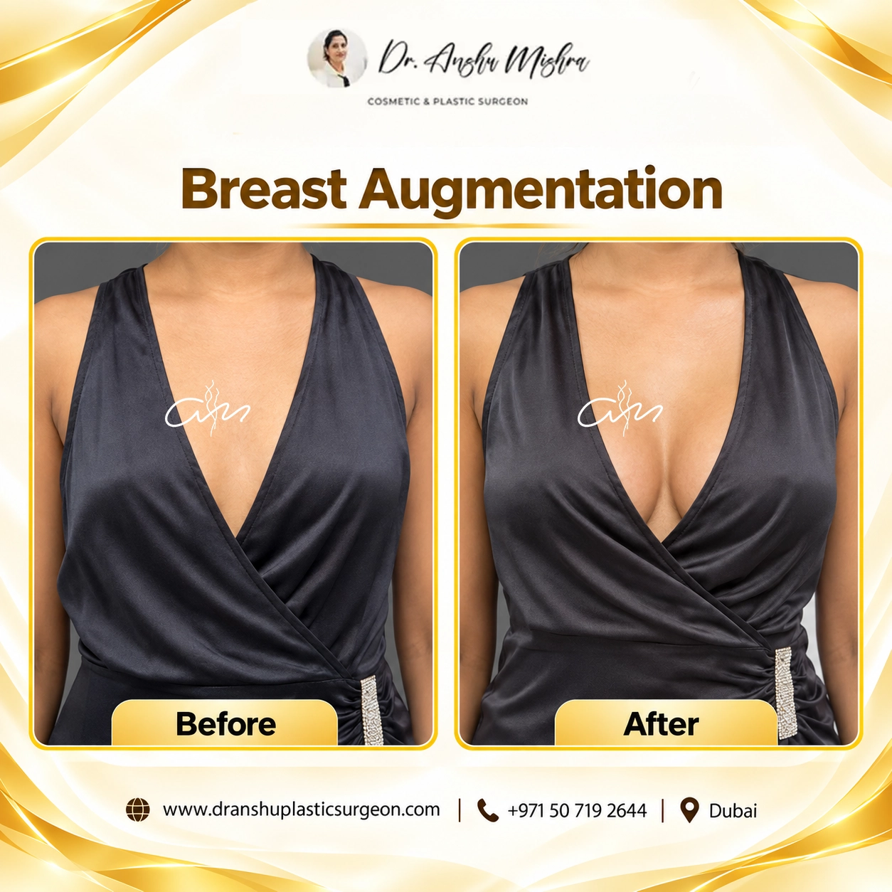 Breast Augmentation