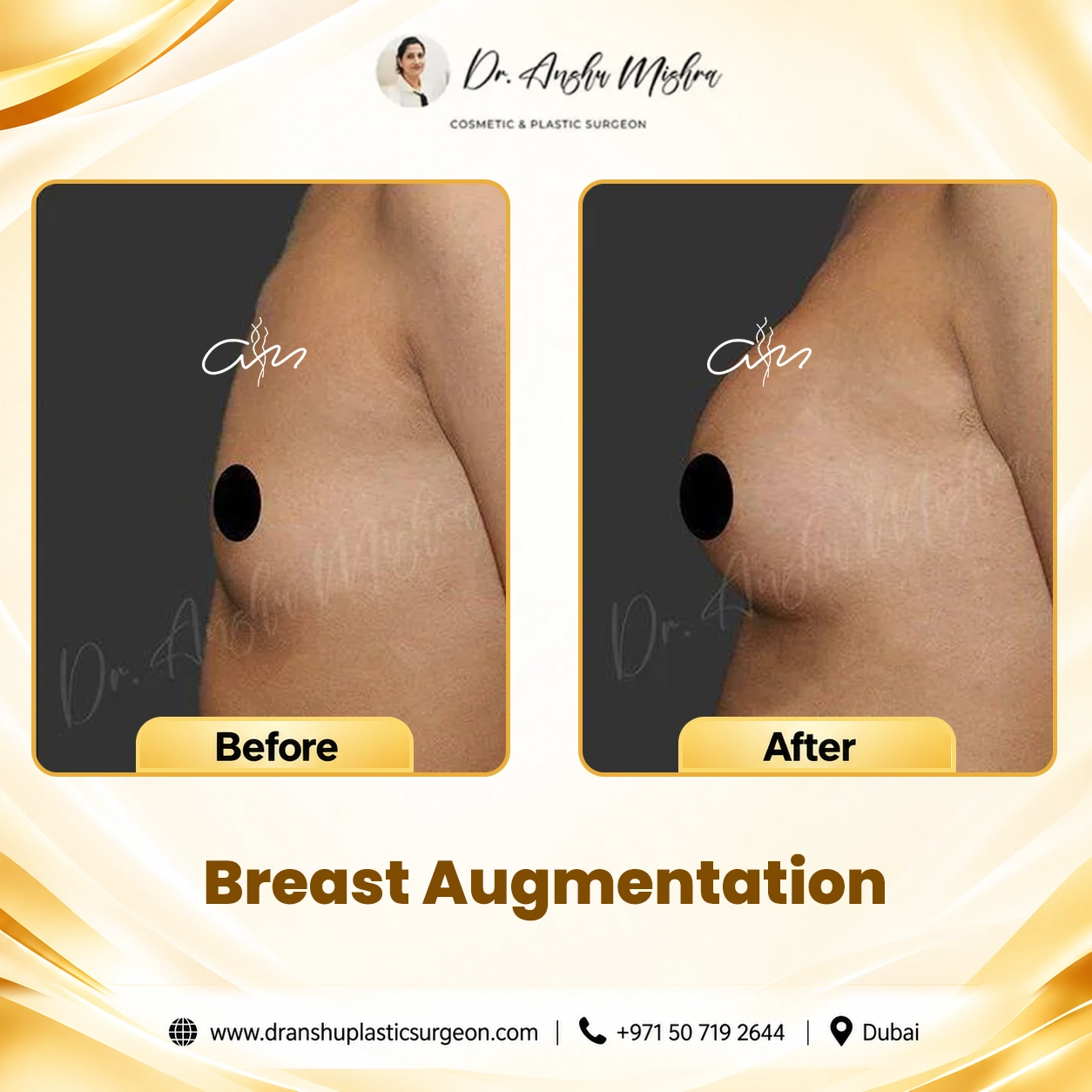 Breast Augmentation