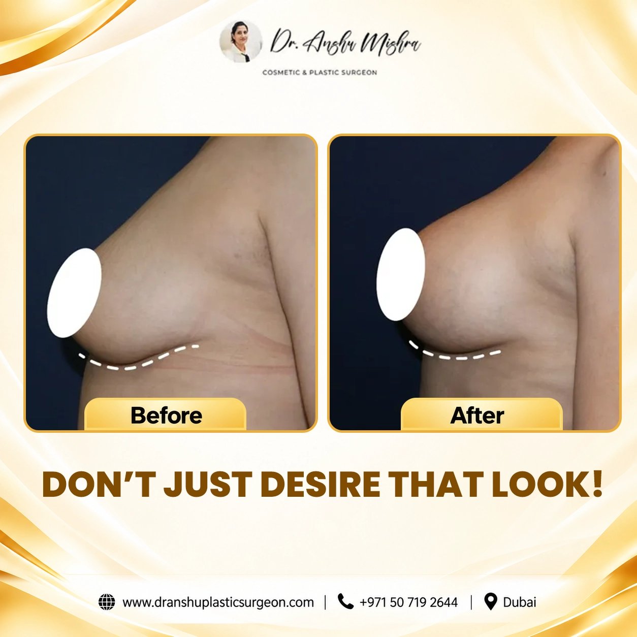 Breast Augmentation