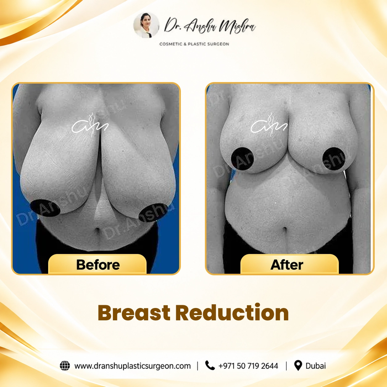 Breast Reduction