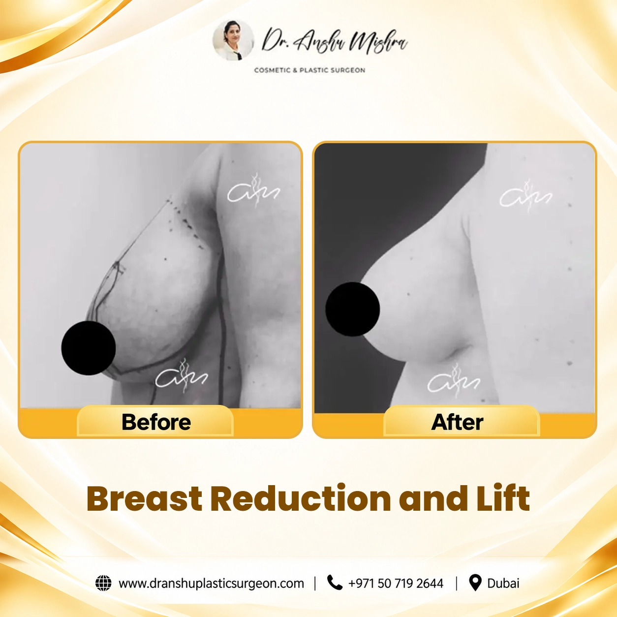 Breast Reduction and Lift