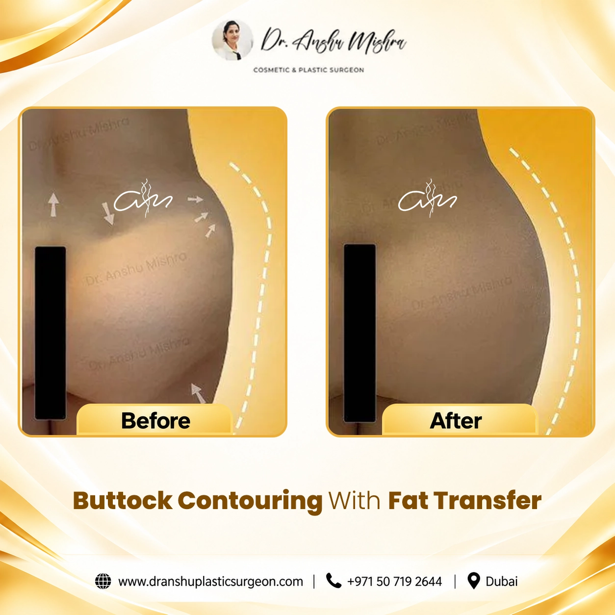 Buttock Contouring With Fat Transfer