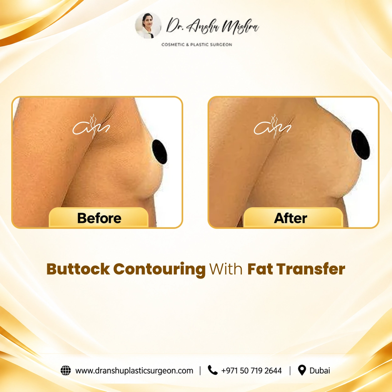 Buttock Contouring With Fat Transfer