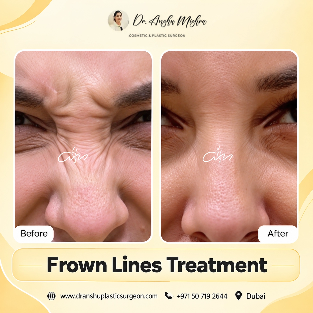 Frown Lines Treatment