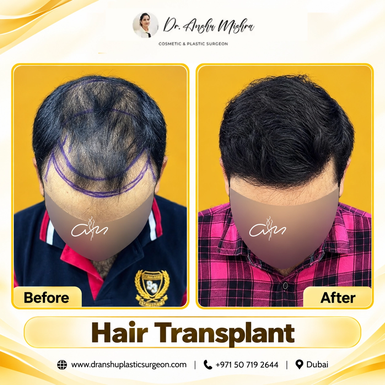 Hair Transplant