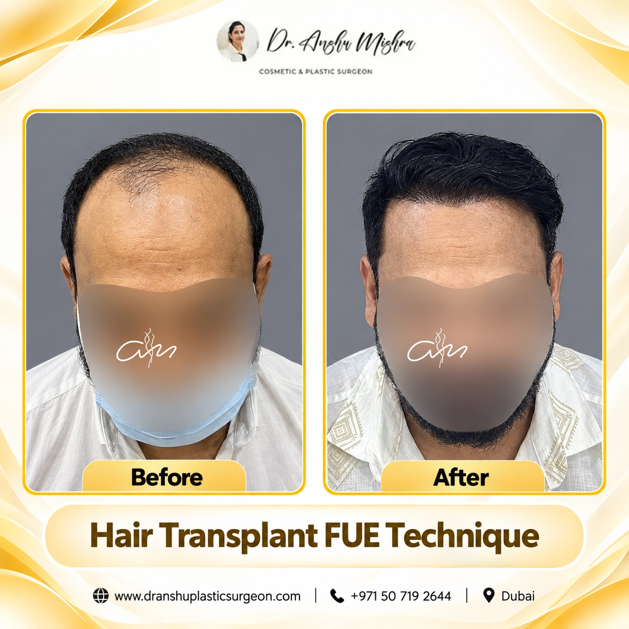Hair Transplant FUE Technique