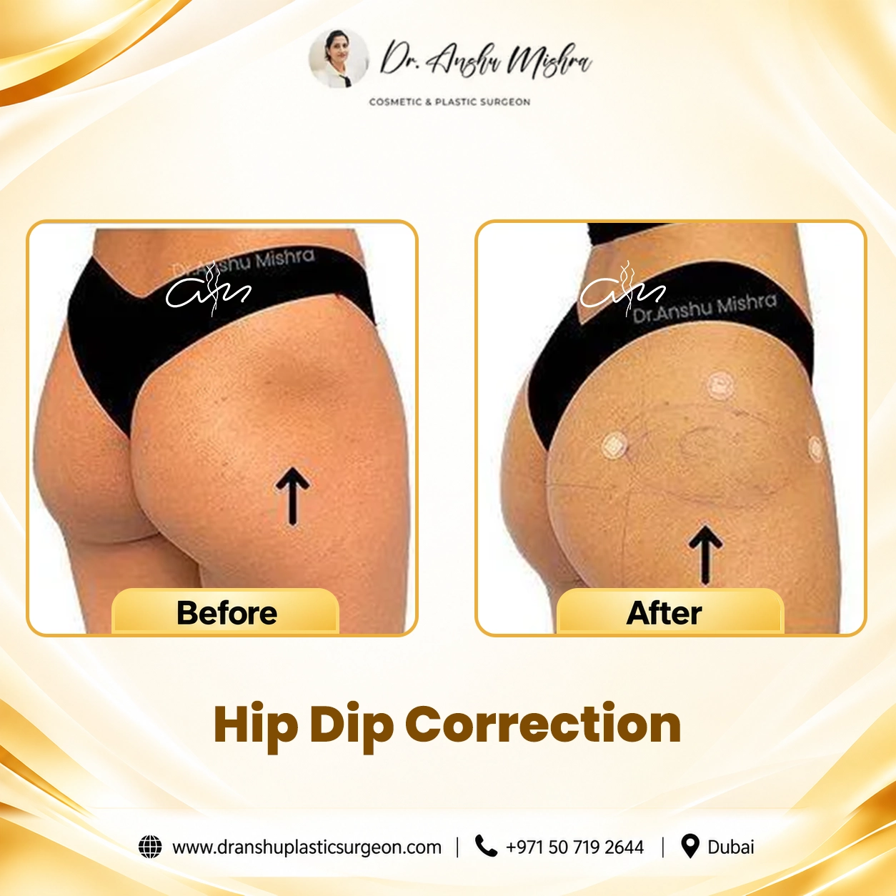 Hip Dip Correction