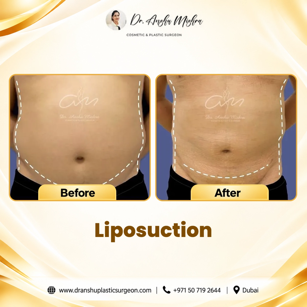 Liposuction
