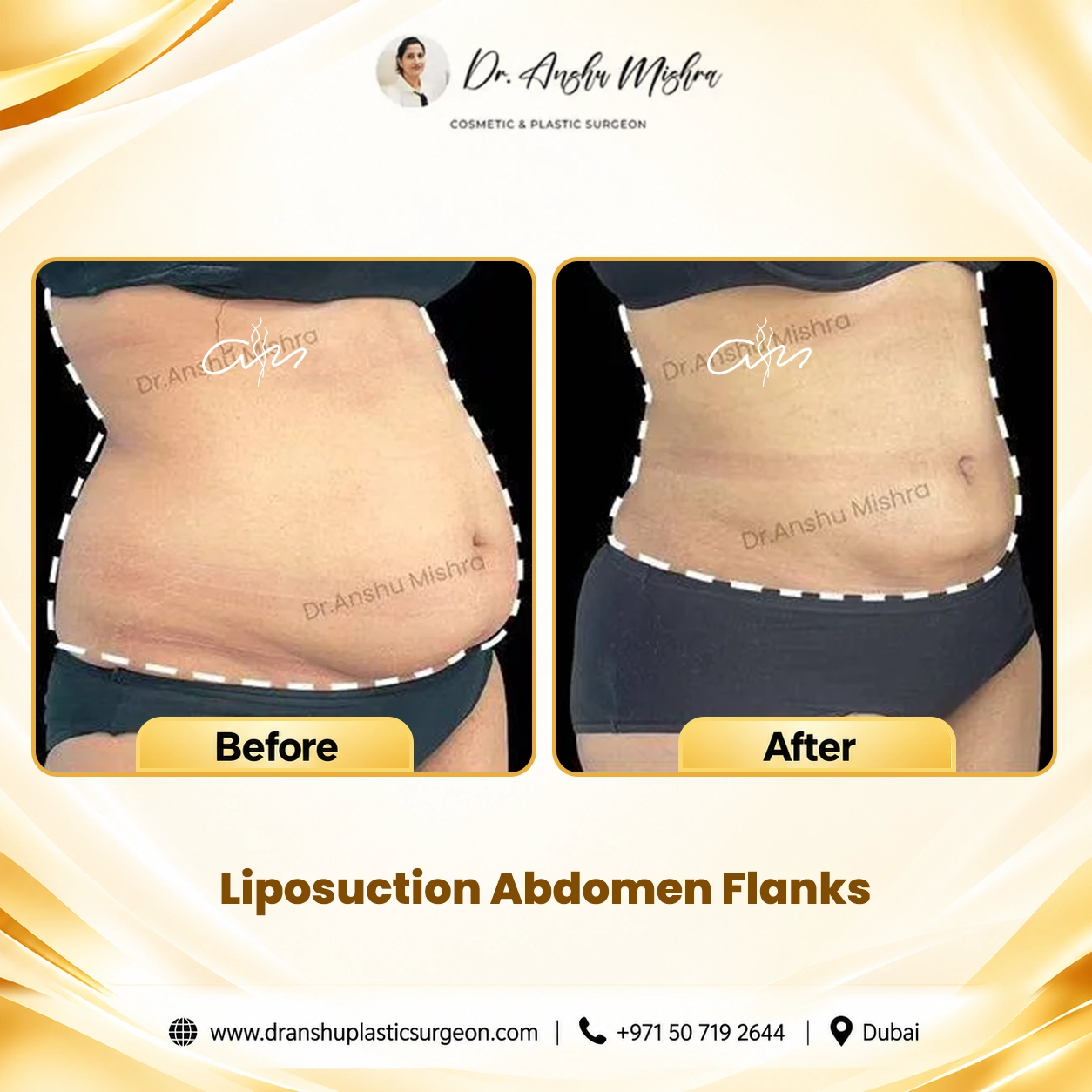 Liposuction Abdomen Flanks