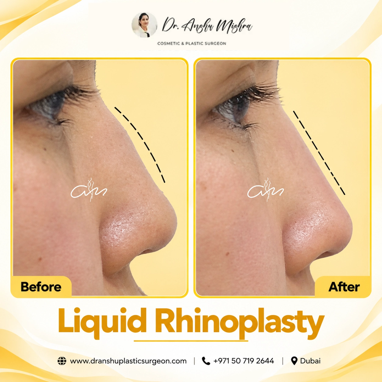Liquid Rhinoplasty