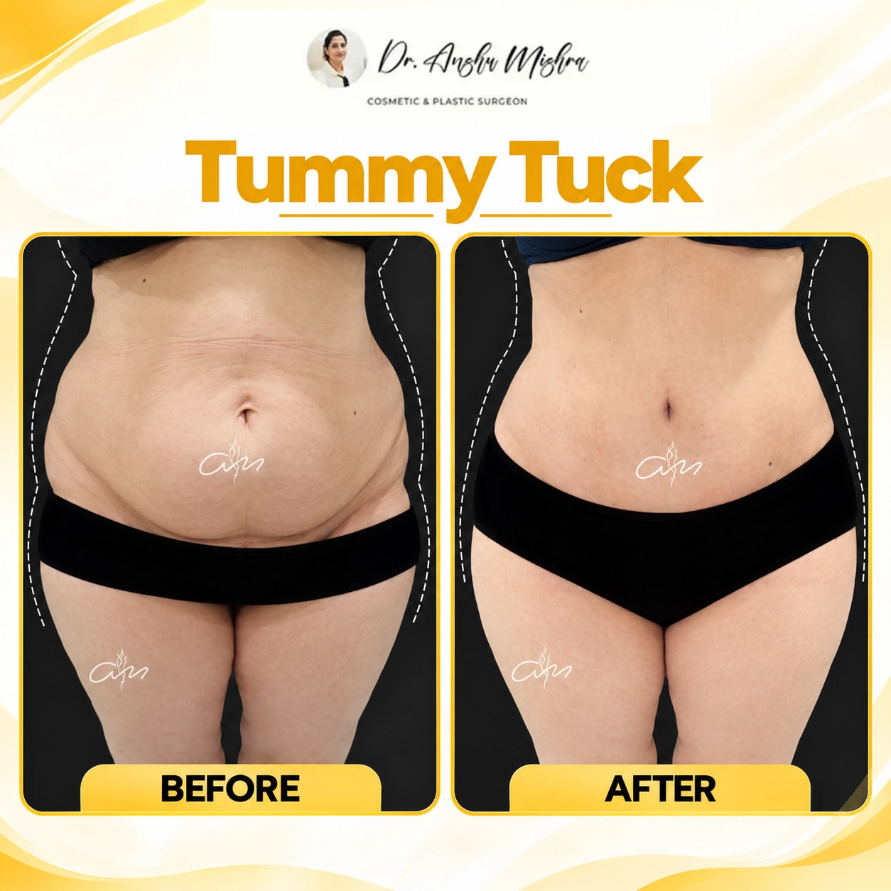 Tummy Tuck