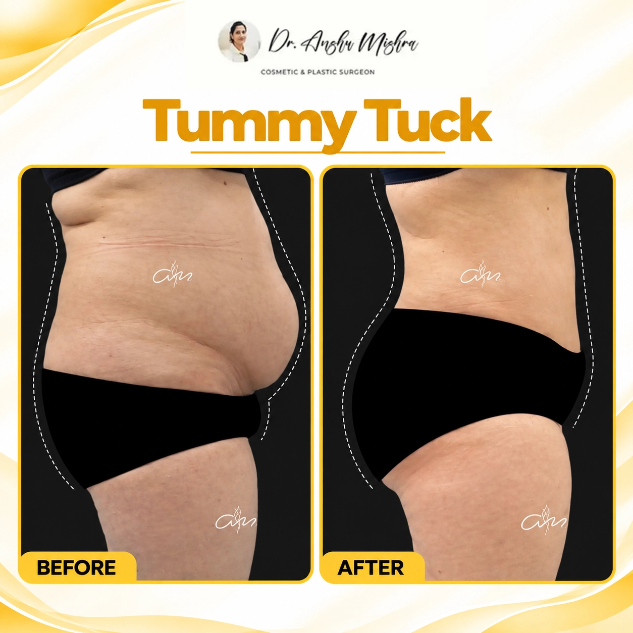 Tummy Tuck