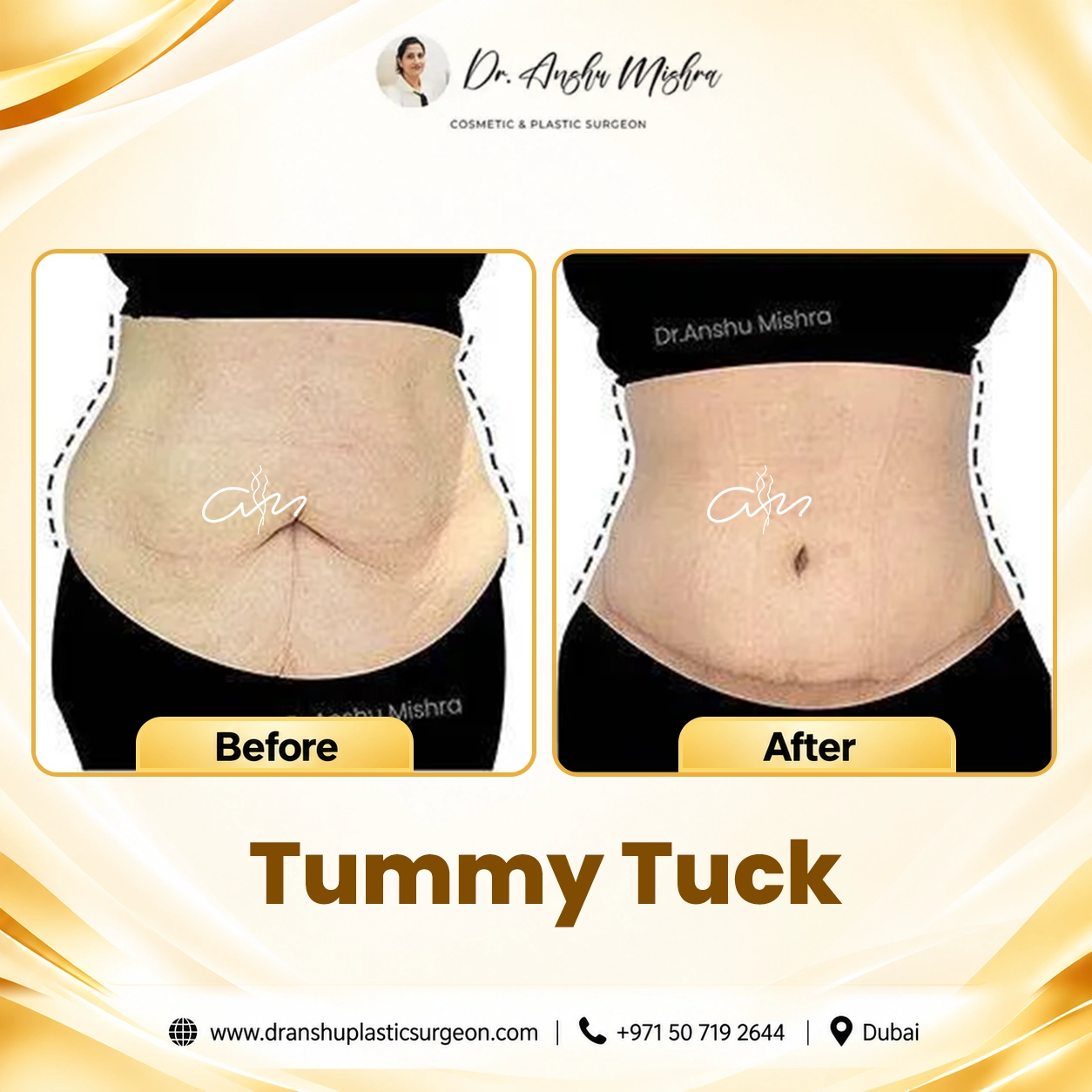 Tummy Tuck