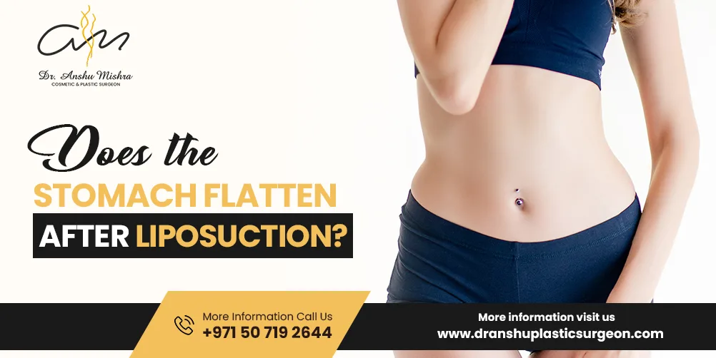 Does the Tummy Flatten After Liposuction?