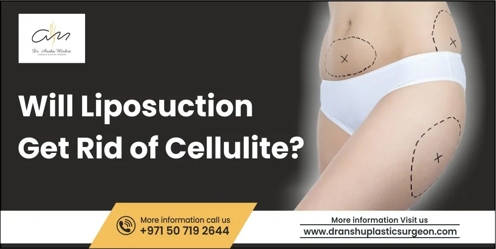 Will Liposuction Get Rid of Cellulite?