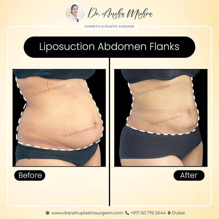 360 Degree Liposuction In Dubai