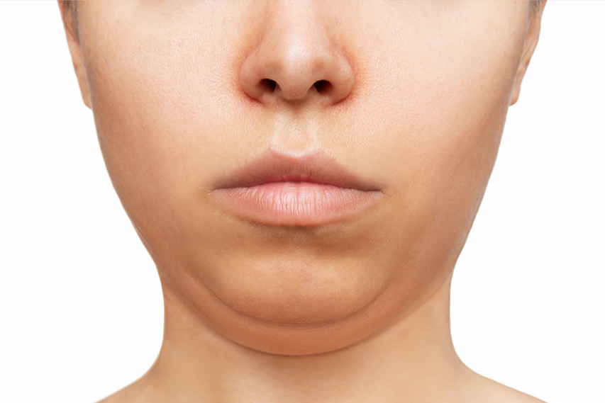 Double Chin Treatment In Dubai