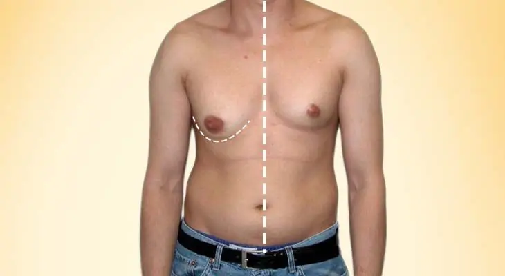 Gynecomastia Surgery In Dubai