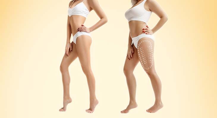 Best Liposuction Treatment In Dubai