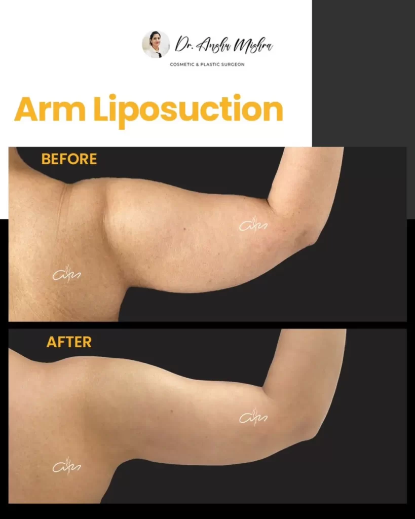 Arm-Liposuction