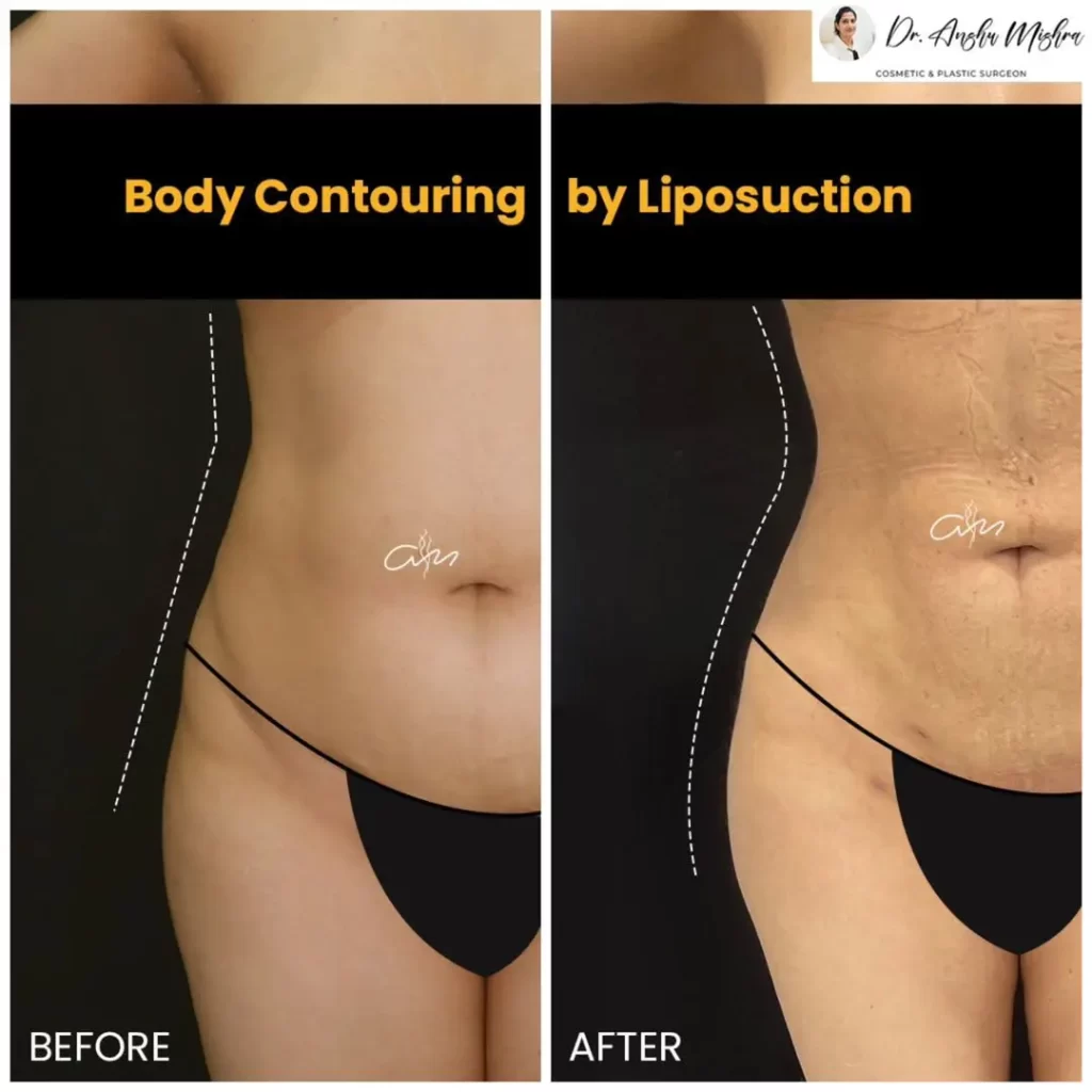 Body-Contouring-Liposuction