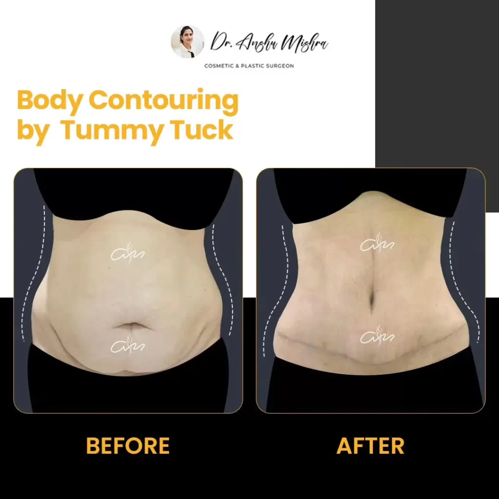 Body-Contouring-TummyTuck