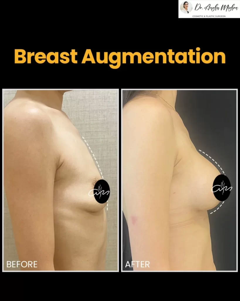 Breast-Augmentation