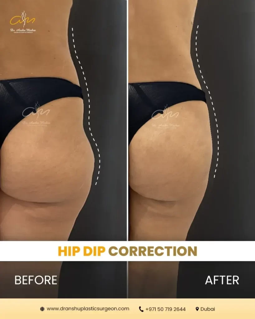 Hip-Dip-Correction