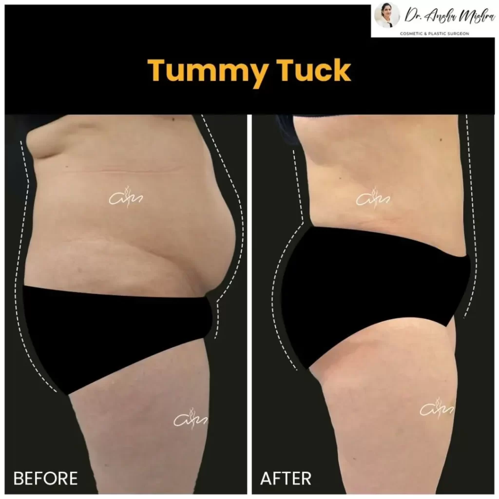 Tummy-Tuck