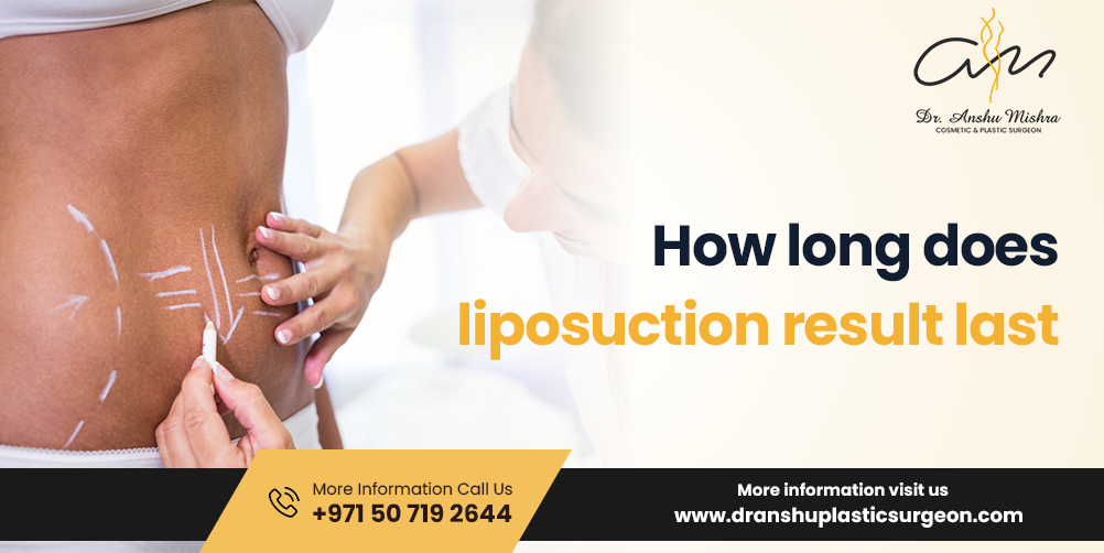 How Long Do Liposuction Results Last?